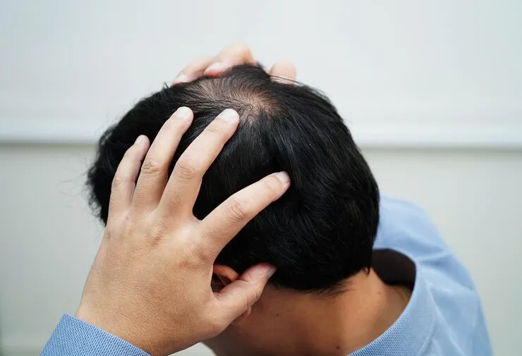 Alopecia Areata: Causes, Symptoms, Stages and Homeopathic Treatment