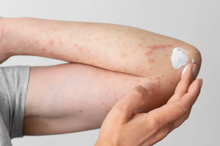 Molluscum Contagiosum: Meaning, Causes and Homeopathic Treatment Explained