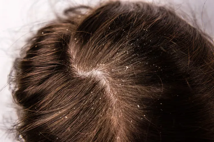 Homeopathic Treatment for Dandruff Causes Remedies and Scalp Care