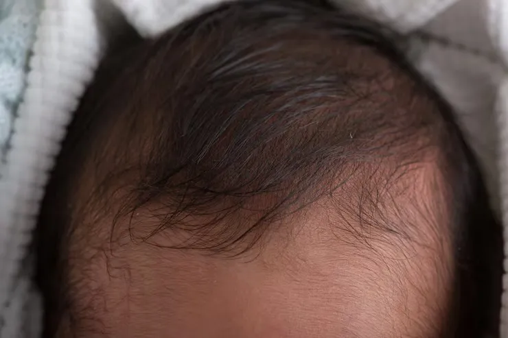 Telogen Effluvium: Why Sudden Hair Fall Happens After Stress, Fever or Illness