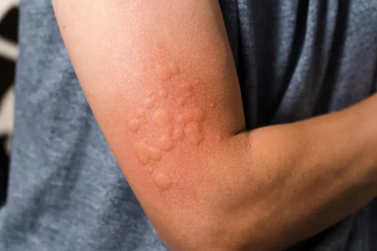 Urticaria Meaning in Hindi: पित्ती का मतलब, कारण, लक्षण और होम्योपैथी उपचार