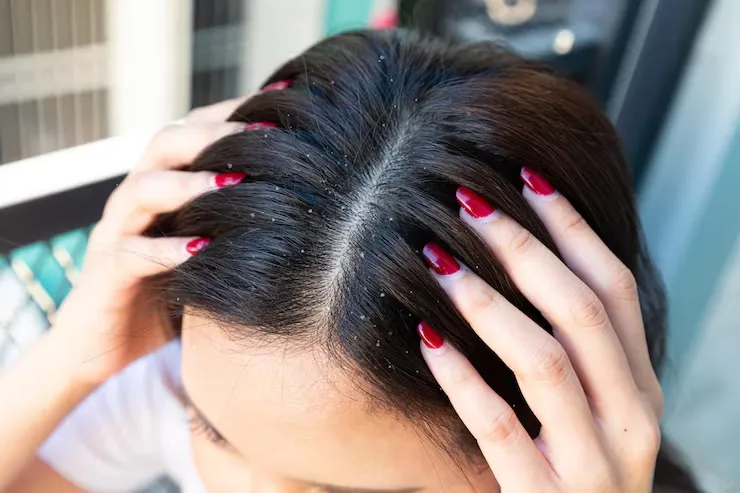 Does Dandruff Cause Hair Loss? Here's What Actually Happens to Your Hair