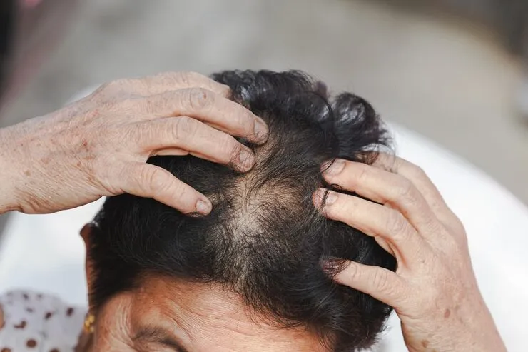 Foods and Diet for Thinning Hair Nutritional Support for Hair Health