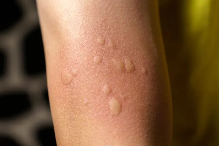 Cure for Molluscum Contagiosum: Treatment and Recovery