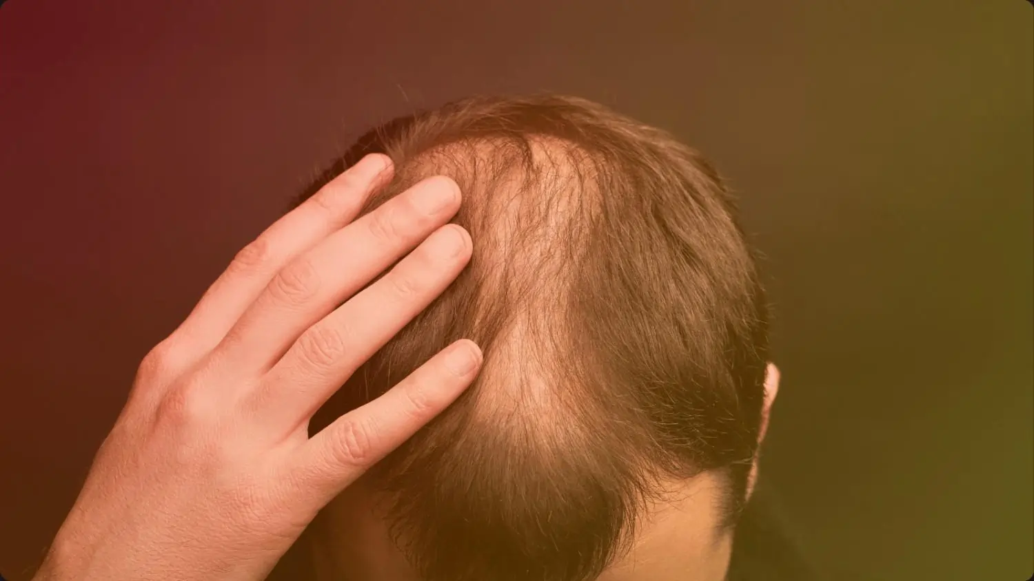 Hair Fall(Alopecia)