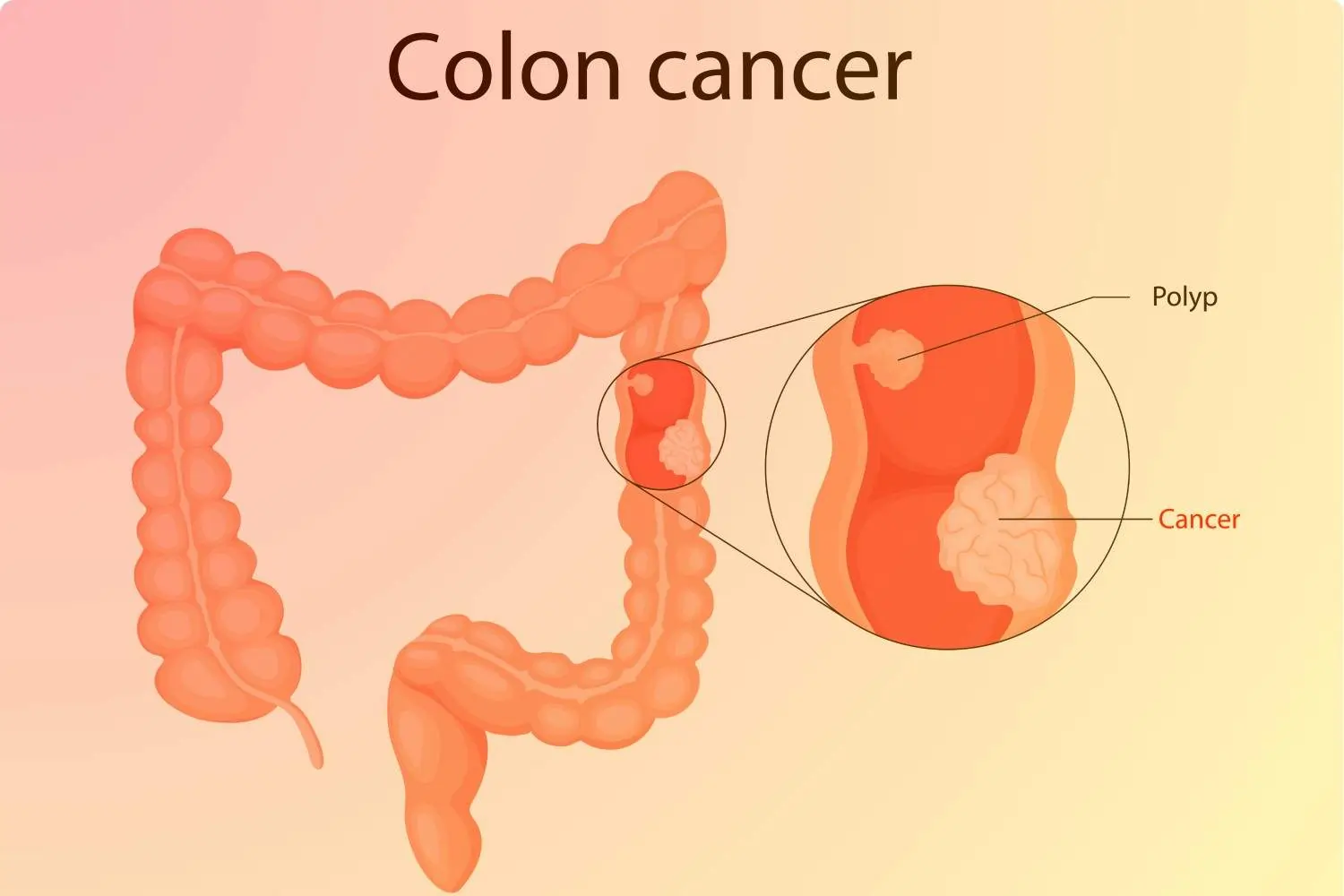 Colon cancer
                                    