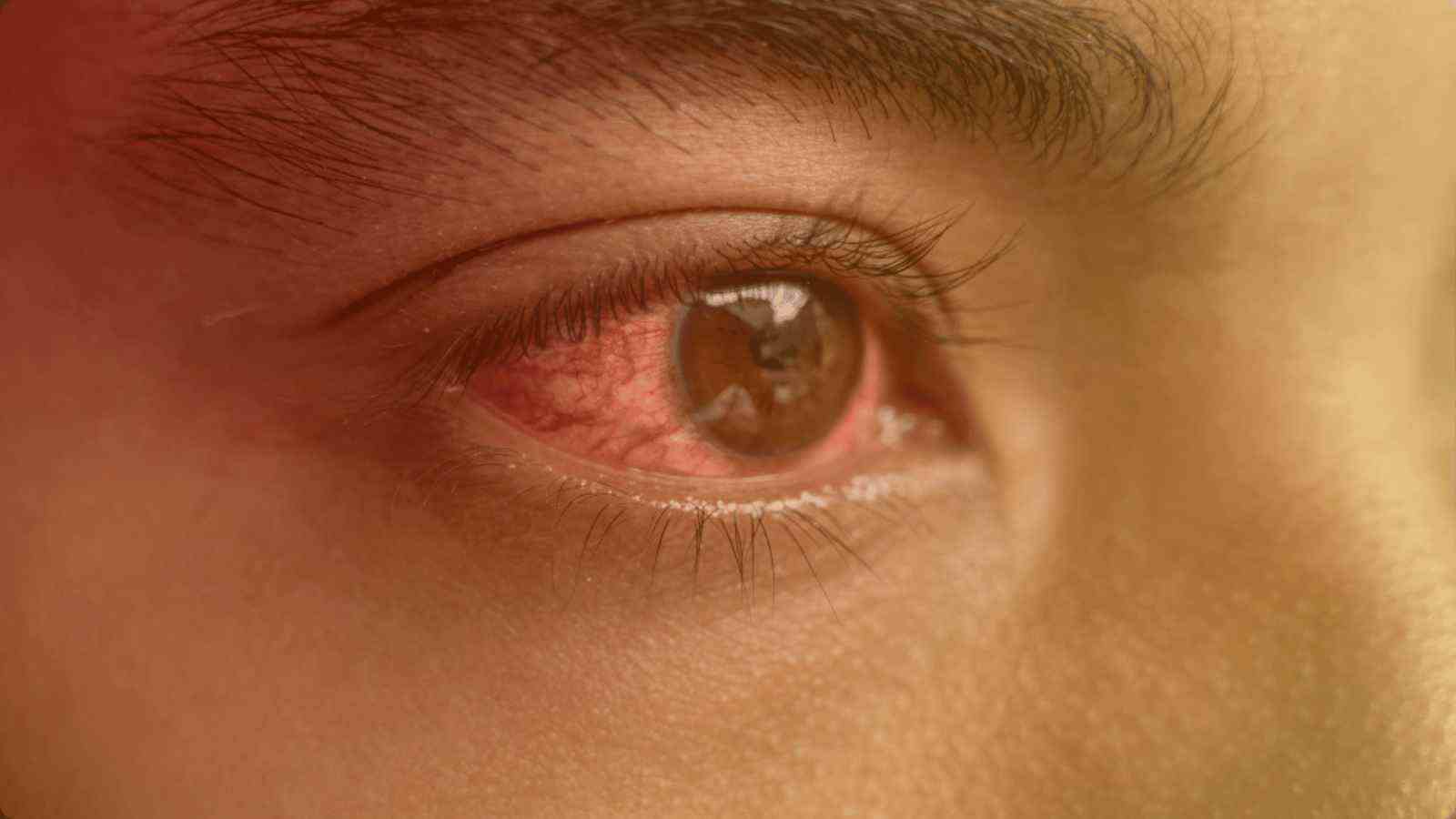 Conjunctivitis                                                