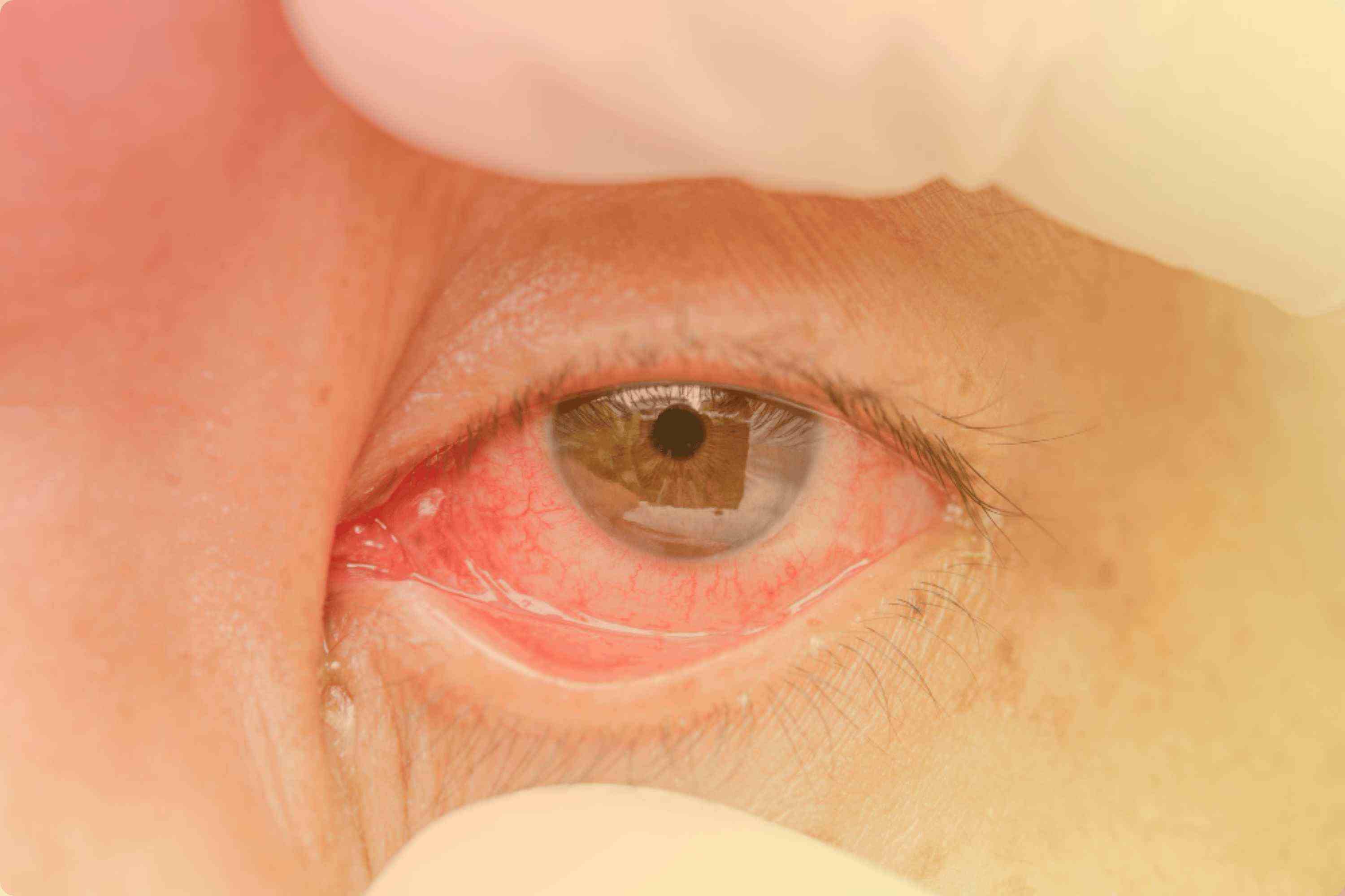 Keratoconjunctivitis
                    