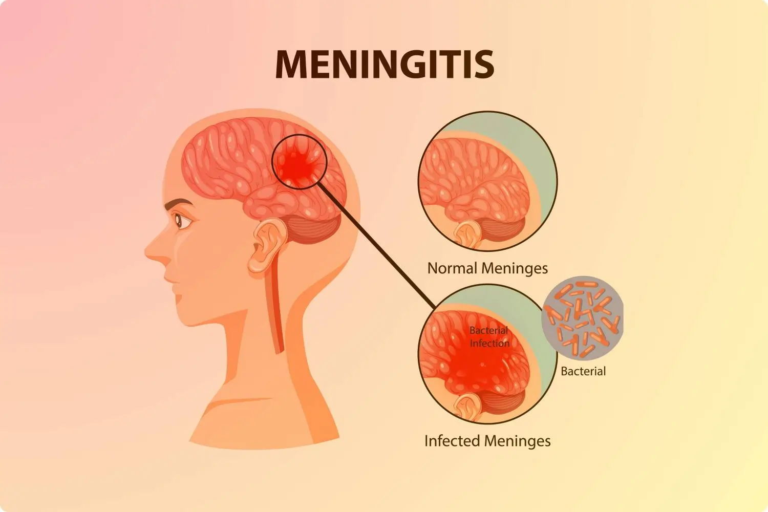 Meningitis
                    