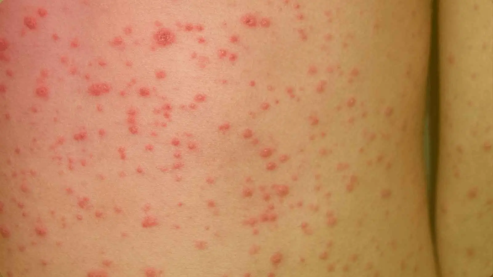 Molluscum
                    Contagiosum
                    