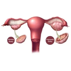 PCOS Homeopathy Treatment