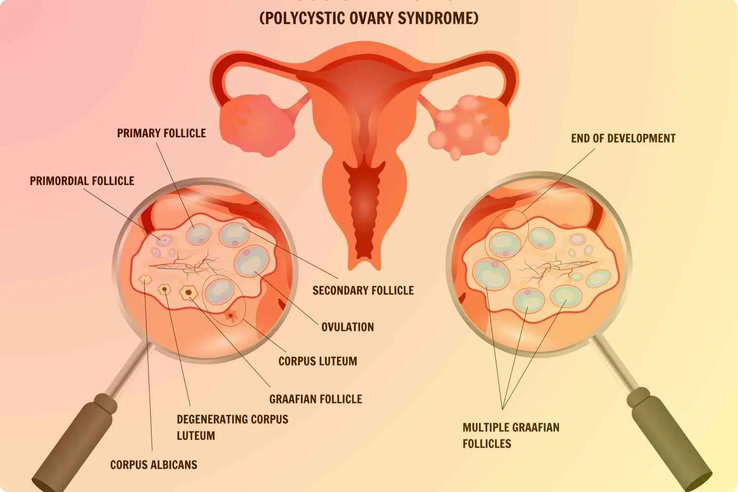 PCOS
                    