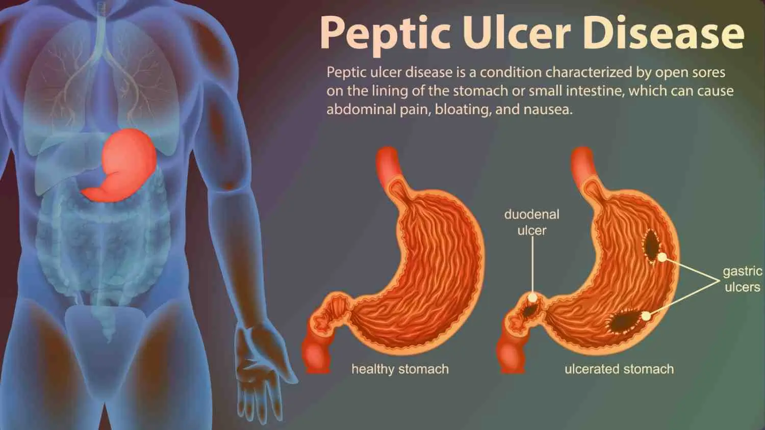 Peptic Ulcer