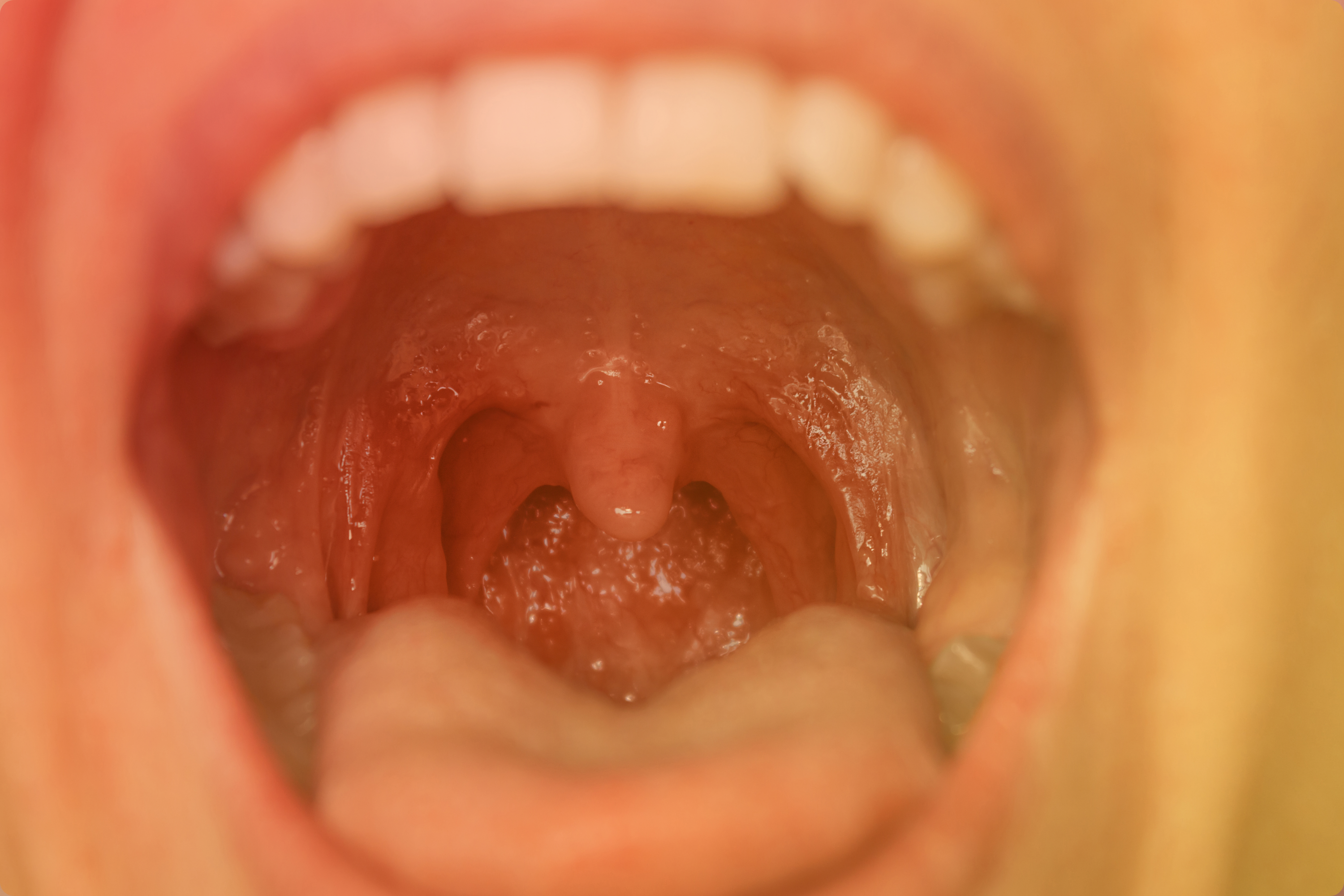 Pharyngitis
                    