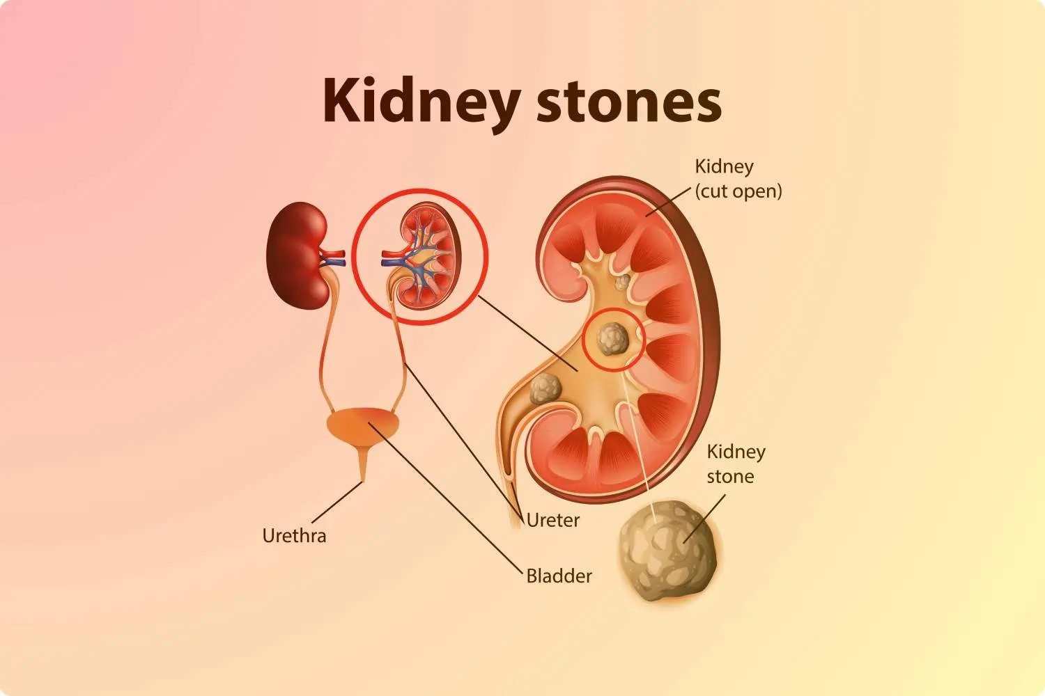 Renal Stone
                    