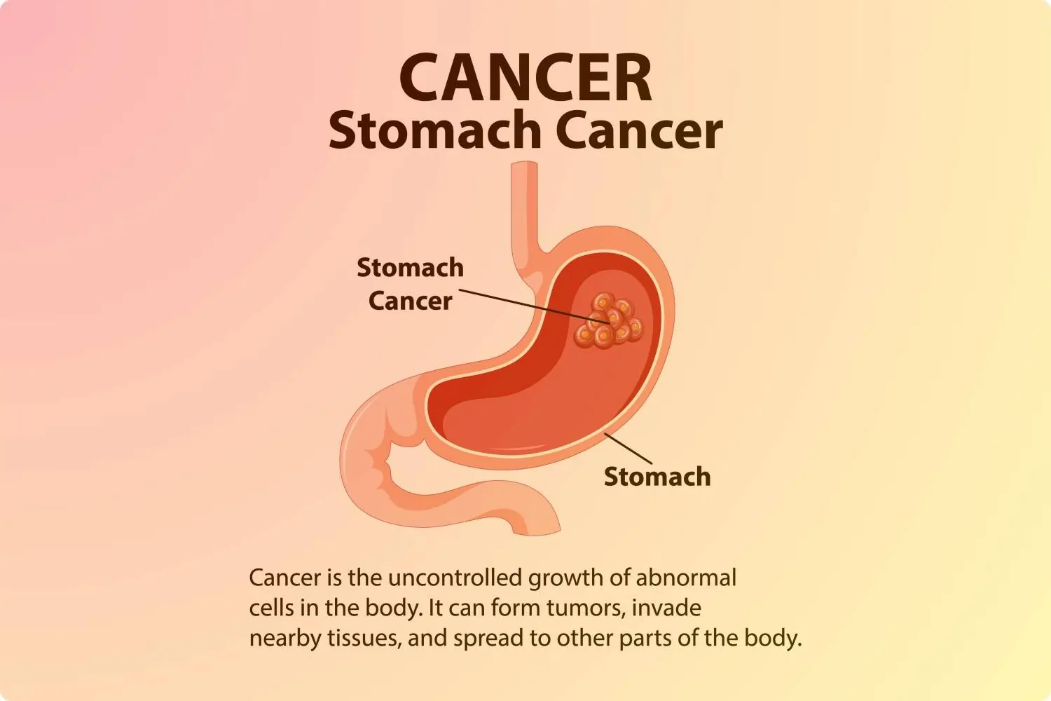 Stomach Cancer /
                    Gastric Cancer
                    