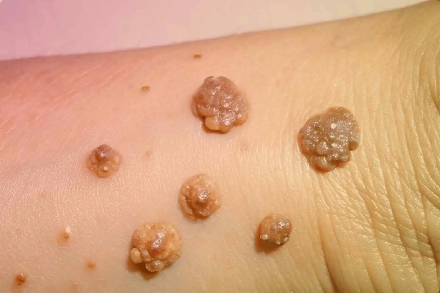 Warts
                    