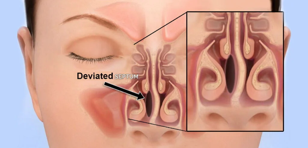 Deviated Nasal
                                    Septum
                                    