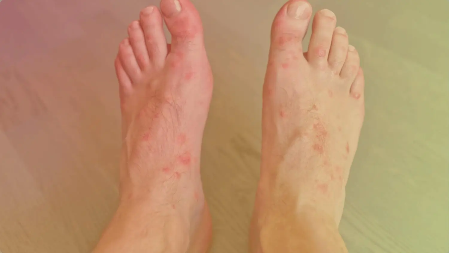 Homeopathy Treatment for Corn