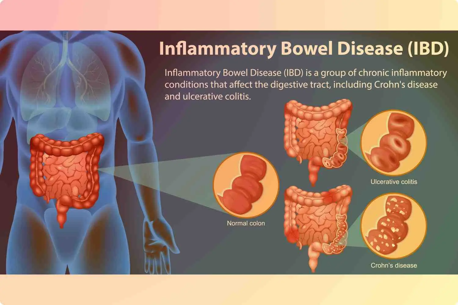 Inflammatory
                    Bowel Disease(IBD)
                    