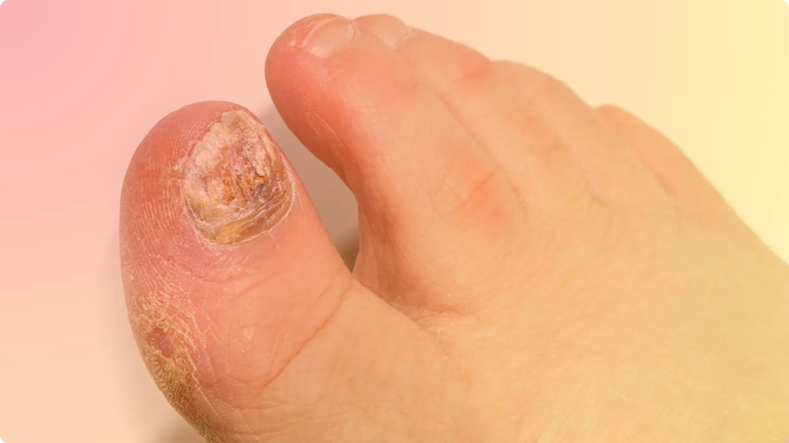 nail-infection