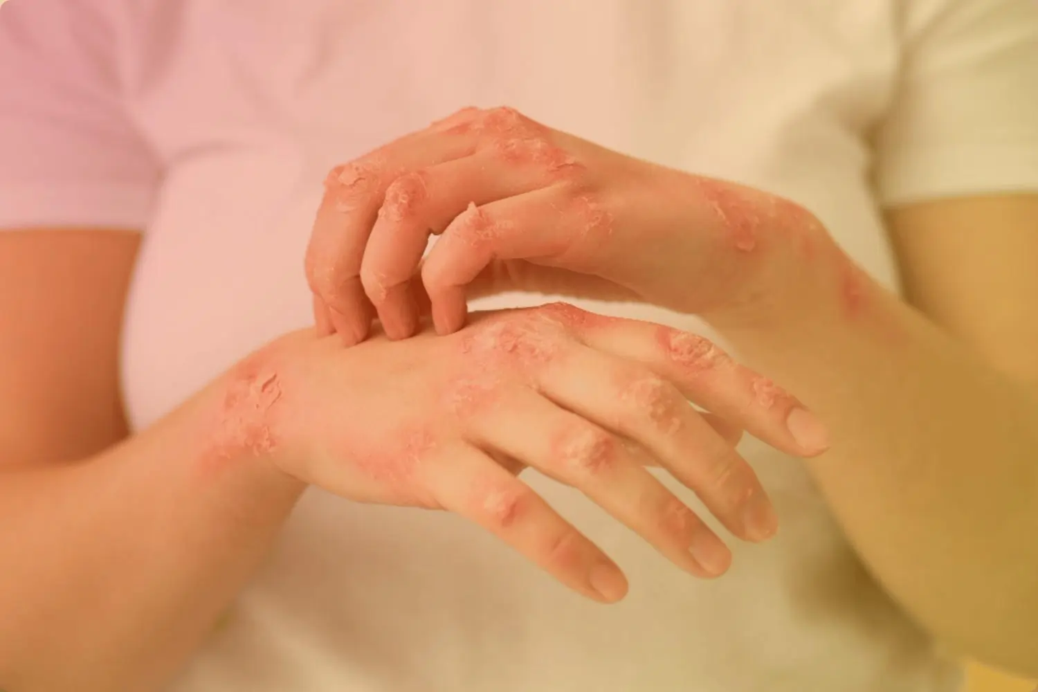 Skin Diseases
                    