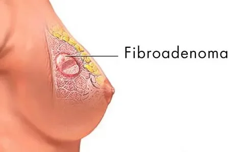 Fibroadenoma
                    