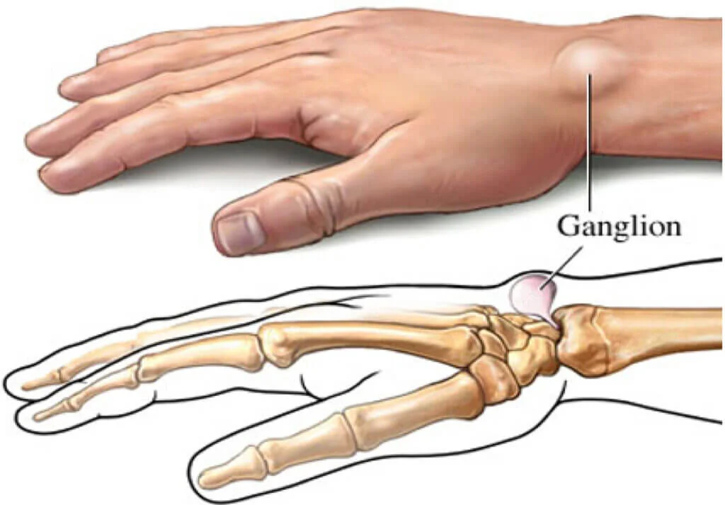 Ganglion Cyst
                    