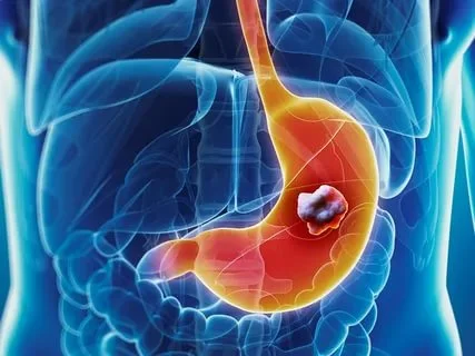 Colon Cancer