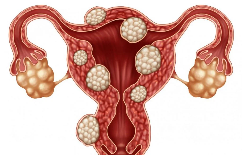 Fibroid
                    