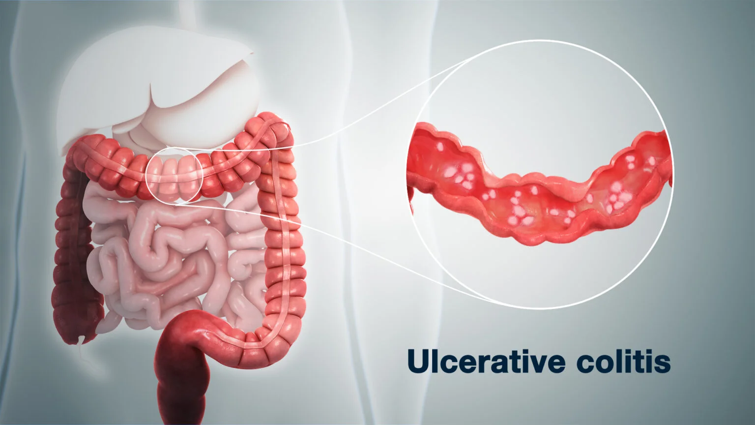 Ulcerative Colitis
                    