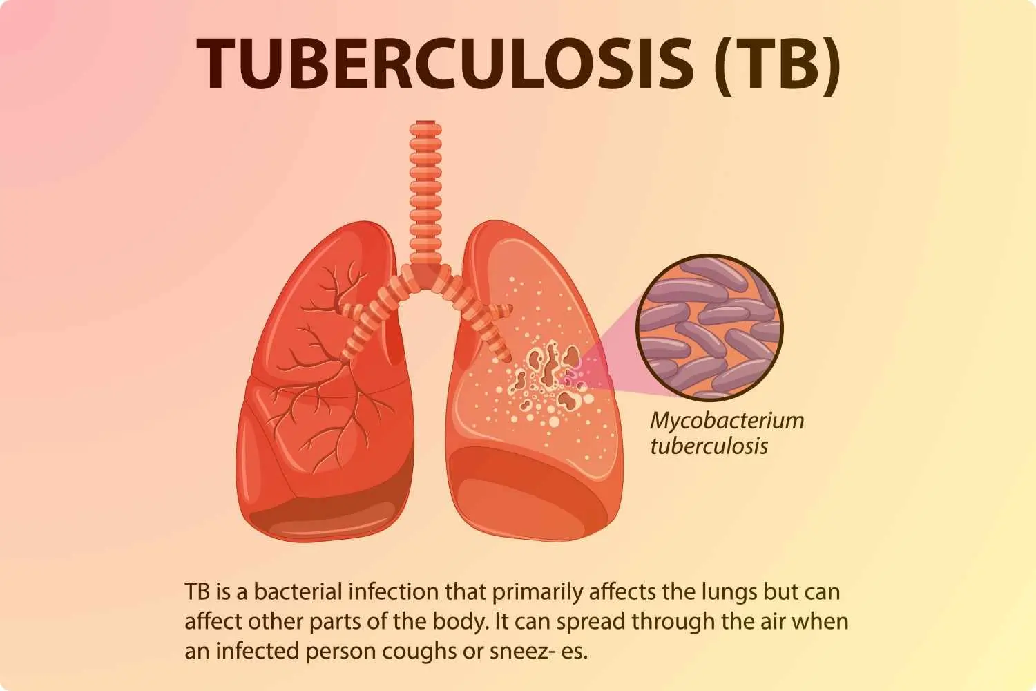 Tuberculosis
                        