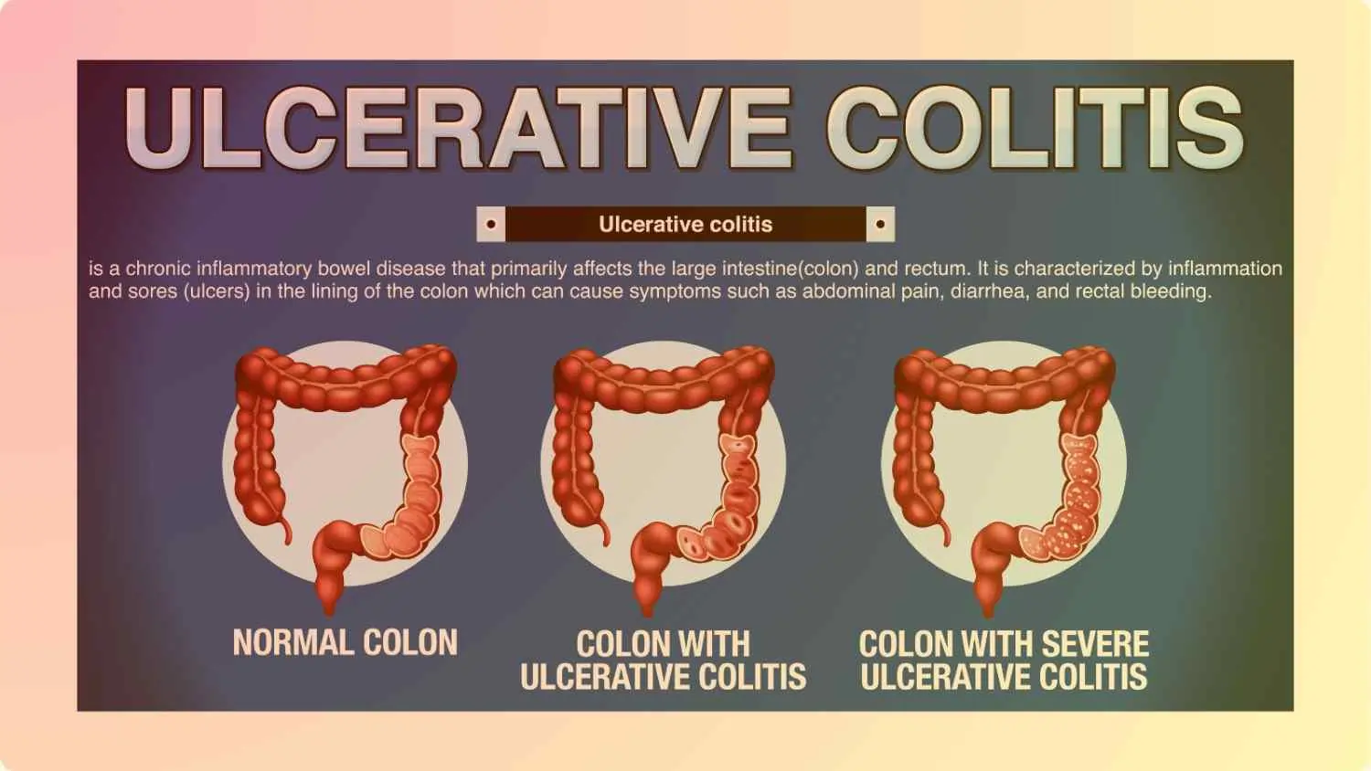 Inflammatory Bowel Disease(IBD)