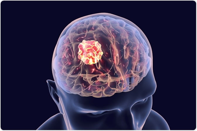 brain-tumor