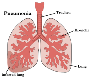Vupdateu-health-tutorial-Pneumonia