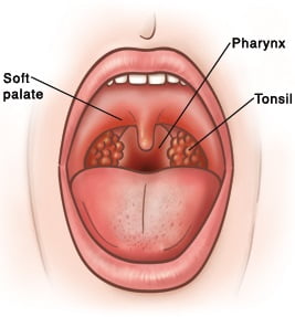 Pharyngitis