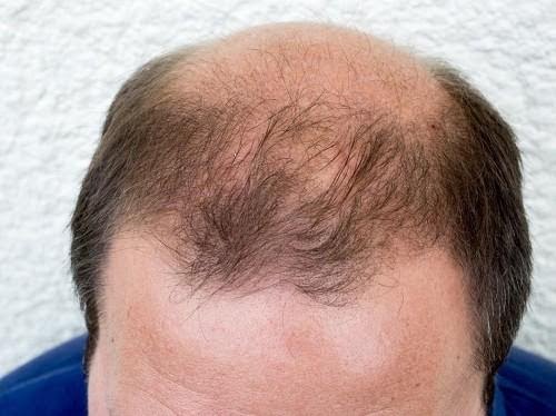 baldness homeopathic treatment