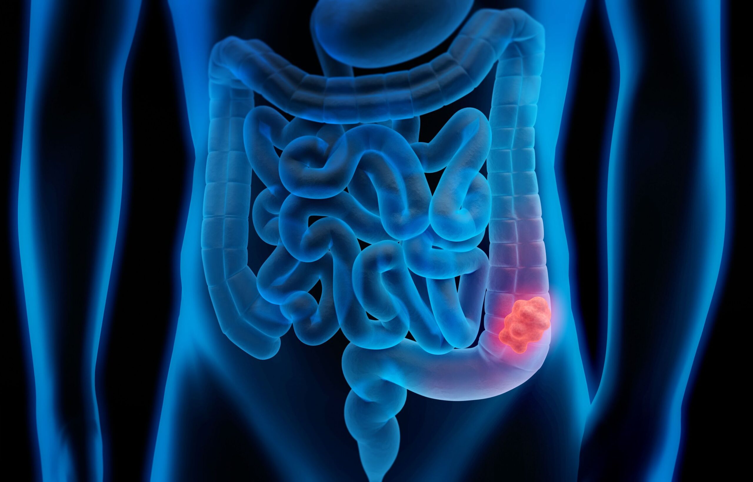 Colon cancer