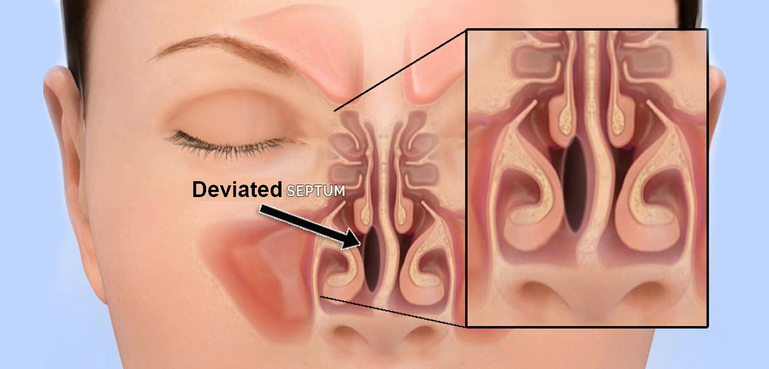 deviated nasal septum types