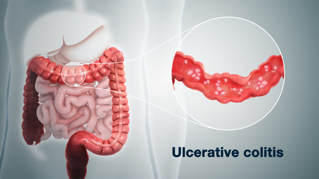 Ulcerative Colitis