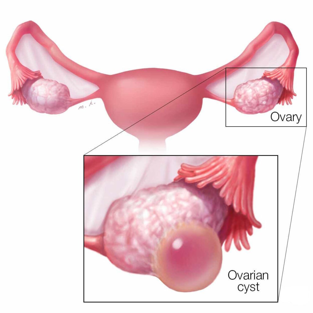 OVARIAN-CYSTS-CAUSES-SYMPTOMS-AND-TREATMENTS