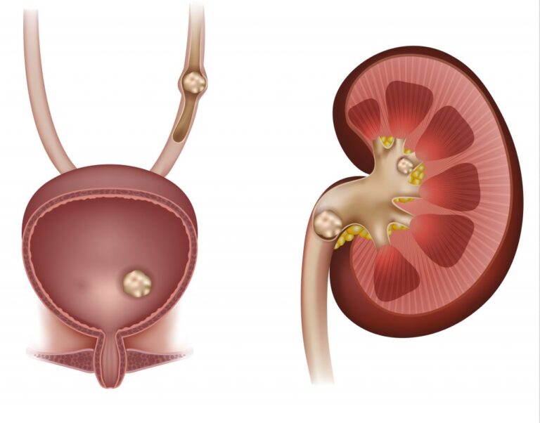 Renal Calculi