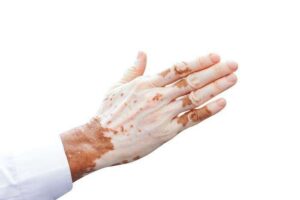 The Role Of Homeopathic Medicines In Treating Vitiligo