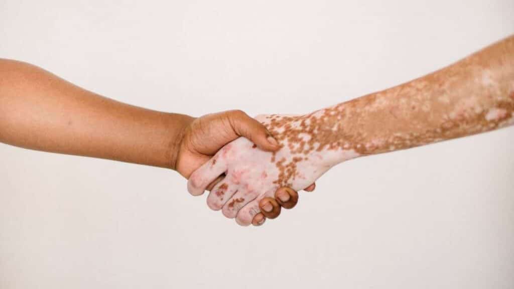 vitiligo homeopathy treatment - Dr.Tathed's Homeopathy