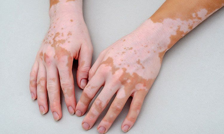 vitiligo homeopathy treatment - Dr.Tathed's Homeopathy