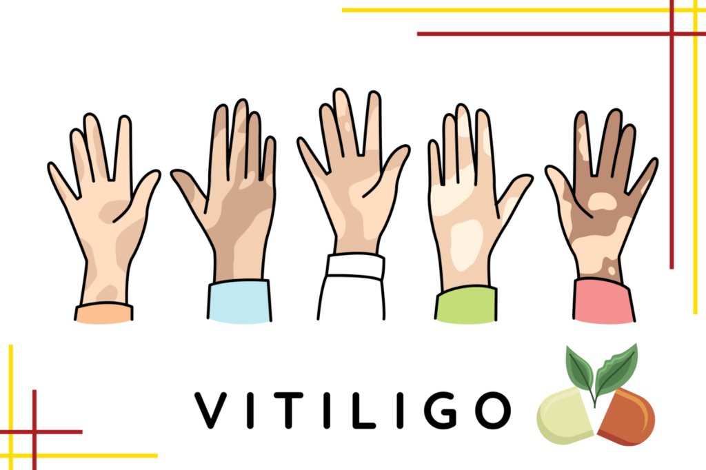 Vitiligo: the disease, the myths, and the miracle cure