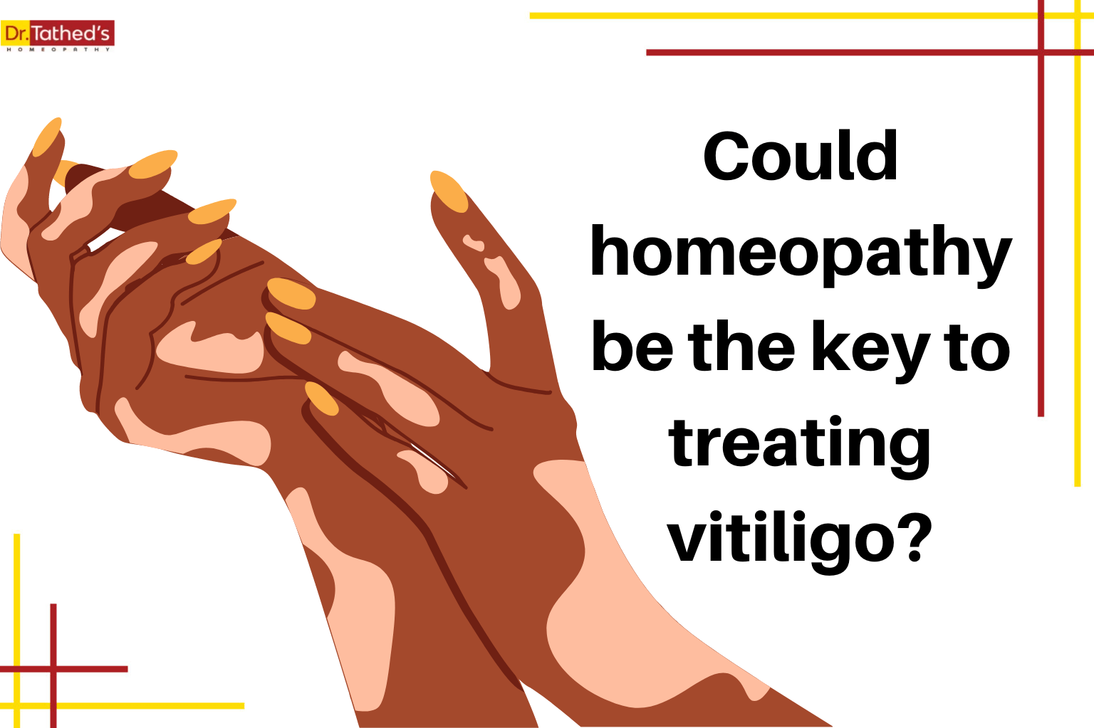 Could homeopathy be the key to treating vitiligo?