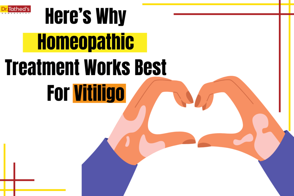Here’s Why Homeopathic Treatment Works Best For Vitiligo