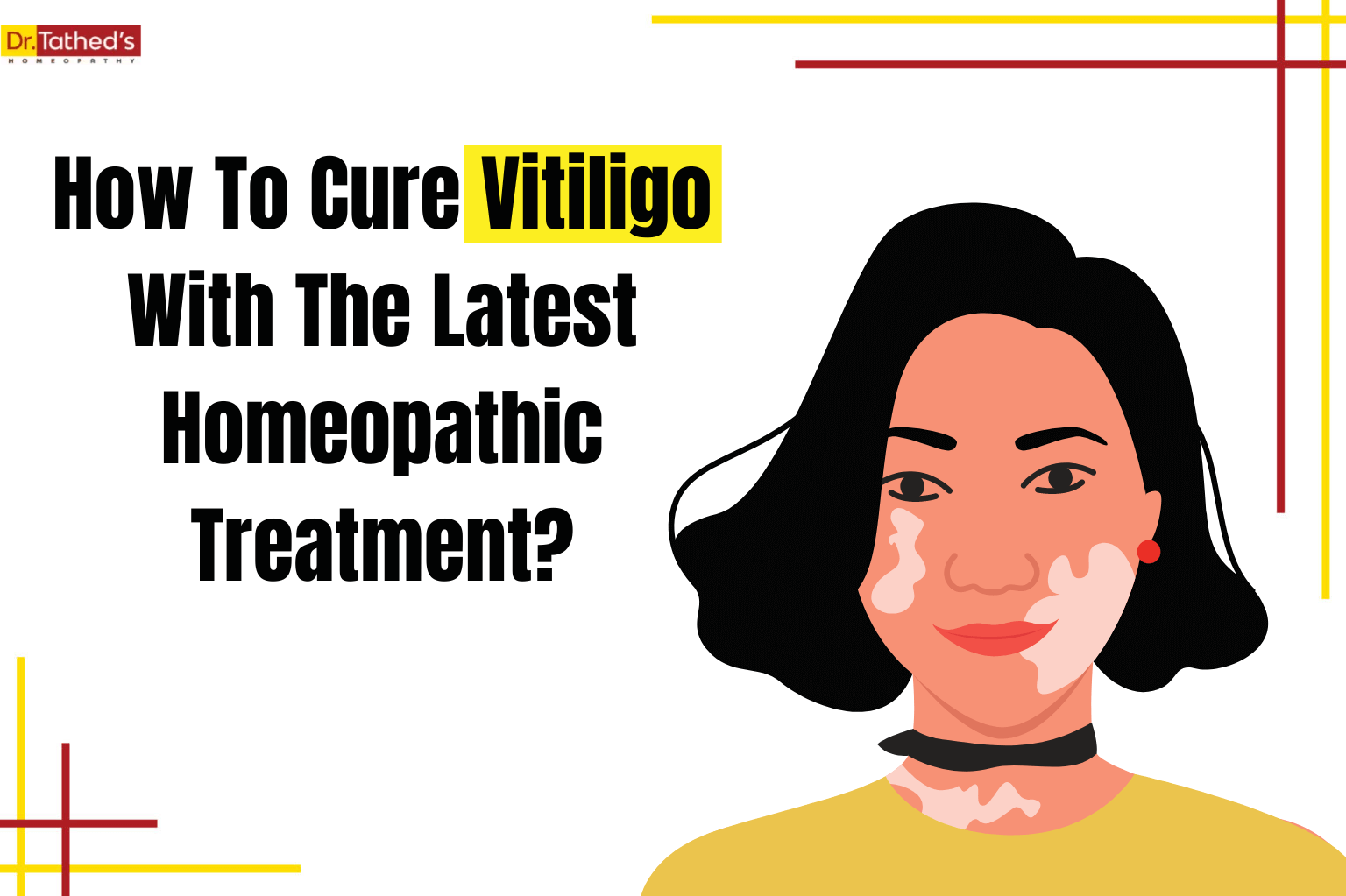 How To Cure Vitiligo With The Latest Homeopathic Treatment?