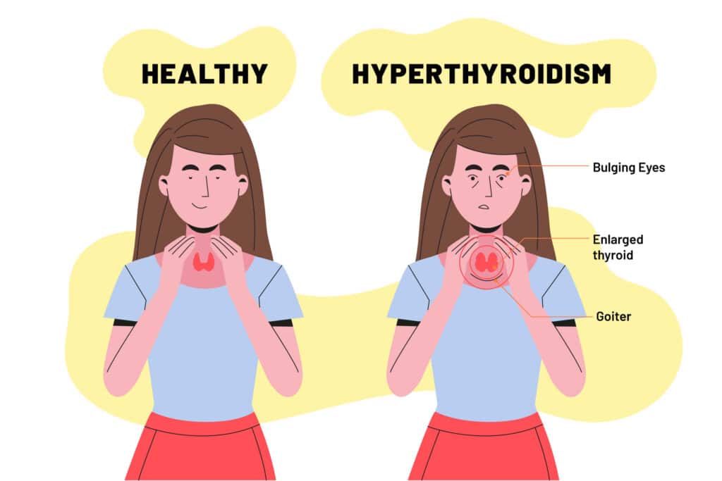 Hypothyroidism 2